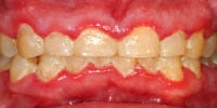 physical examination : swollen gums